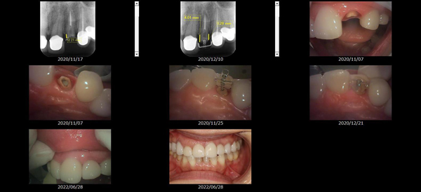 MTMを使用した治療画像