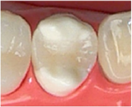 ハイブリッドセラミック