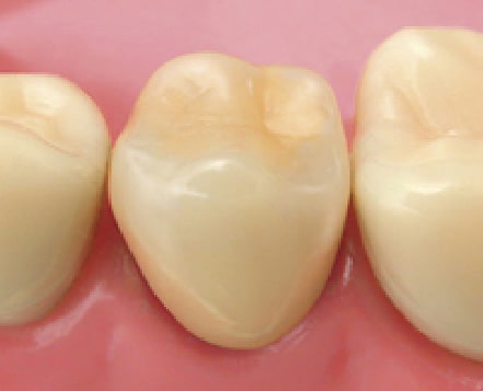 プラスチック前装冠