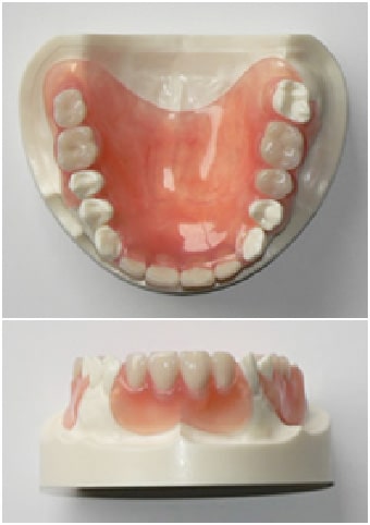 磁性アタッチメント（維持装置）