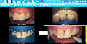 ラバーダムを使用した治療画像