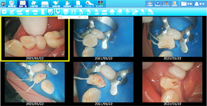 ラバーダムを使用した治療画像