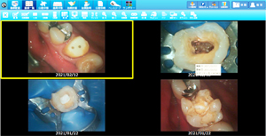 ラバーダムを使用した治療画像