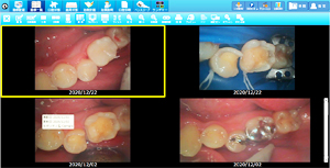 ラバーダムを使用した治療画像