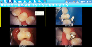 ラバーダムを使用した治療画像
