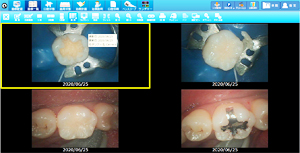 ラバーダムを使用した治療画像